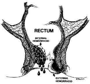 Best hospital for piles treatment in Florida